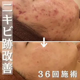 ミディアム カラー パーマ ヘアアレンジ メンズ キッズ ネイル マツエク・マツパ アイブロウ 夏までに肌荒れ卒業 するサロン🌻のエステ・リラクイメージ