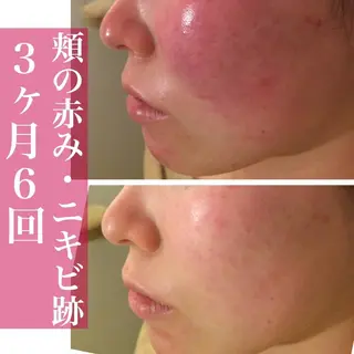 セミロング カラー パーマ ヘアアレンジ メンズ キッズ ネイル マツエク・マツパ 都内で出来る肌管理！ 最短ニキビ改善のエステ・リラクイメージ