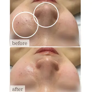 ハーブピーリング🌹 Homieのエステ・リラクイメージ