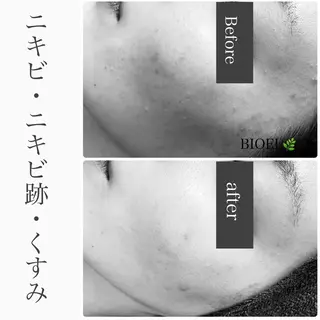 BeSkin藤沢店所属・ニキビ/肌質改善 BeSkin 藤沢店のエステ・リラクイメージ