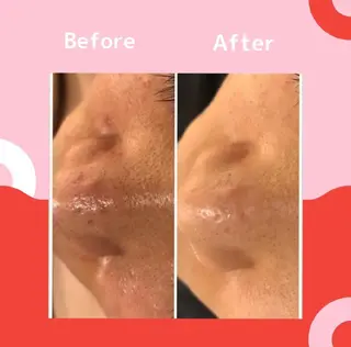 夏までに肌荒れ卒業 するサロン🌻のエステ・リラクイメージ