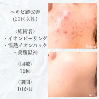 6万人の美肌実績🔥 最短ニキビ改善のエステ・リラクイメージ