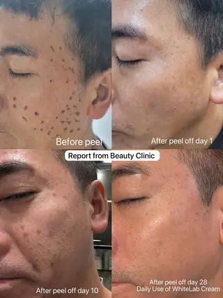 肌改善グリーンピール 東川口/浦和美園のエステ・リラクイメージ