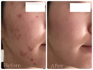 ニキビ・ 肌荒れ専門店のエステ・リラクイメージ