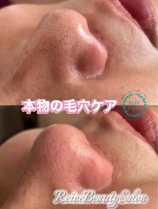 Reine BeautySalon所属・毛穴/シミ肝斑/脱毛 横山梨里のエステ・リラクイメージ