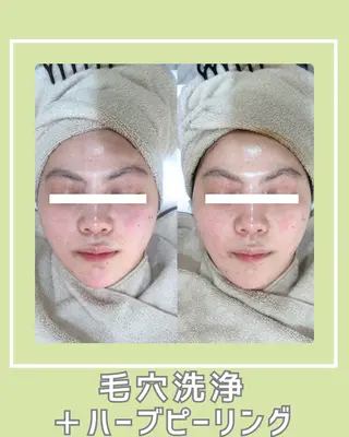 |ピーリング・毛穴| soina神楽坂のエステ・リラクイメージ