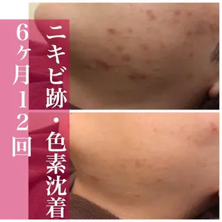 セミロング カラー パーマ ヘアアレンジ メンズ ネイル マツエク・マツパ 都内で出来る肌管理！ 最短ニキビ改善のエステ・リラクイメージ