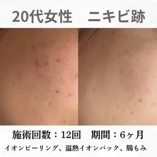 重度ニキビ専門🌷 ダウンタイムなしのエステ・リラクイメージ