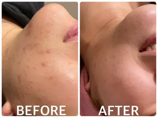 ハーブピーリング 横浜のエステ・リラクイメージ