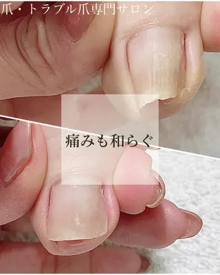 ネイル 深爪・巻き爪 専門サンセリテのネイルデザイン