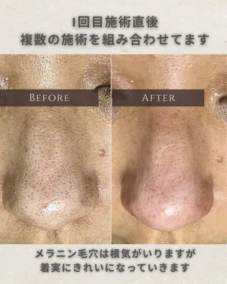 シミ毛穴|眉Wax THE  flowのエステ・リラクイメージ