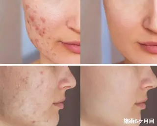 顔脱毛＆毛穴＆ニキビ 優良№1♪ヒロコ♪のエステ・リラクイメージ