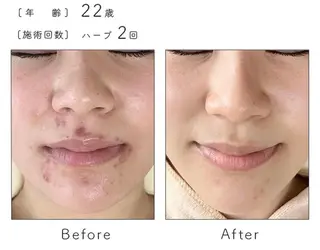 ハーブピーリング専門 BIOPLUS＋川崎のエステ・リラクイメージ