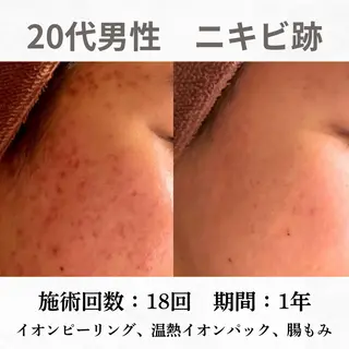 重度ニキビ専門🌷 ダウンタイムなしのエステ・リラクイメージ