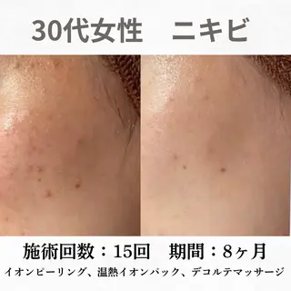 重度ニキビ専門🌷 ダウンタイムなしのエステ・リラクイメージ