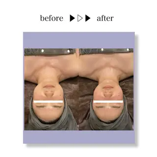 ☆痩身/小顔☆ ハイパーナイフexのエステ・リラクイメージ