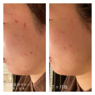 セミロング カラー パーマ ヘアアレンジ メンズ キッズ ネイル マツエク・マツパ ニキビ跡専門サロン Ainaのエステ・リラクイメージ