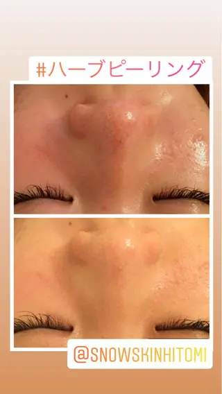 ニキビ/肌質改善専門 Snow skinのエステ・リラクイメージ