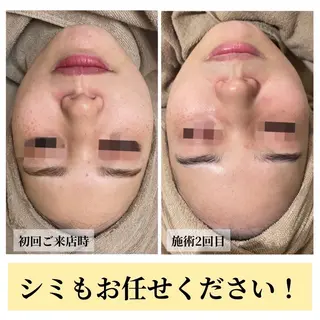 ハーブピーリング・毛穴ケア専門サロンSalon de LENA所属・ハーブピーリング 専門店/名古屋駅前店のその他イメージ