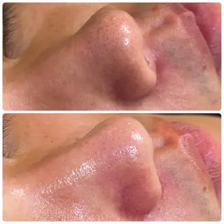 鍼灸•マッサージサロンCalfa所属・《美肌･小顔》美容鍼 ＆マッサージ＊MEIのエステ・リラクイメージ