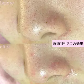 タルミ,ニキビケア専門PICHi BEAUTeピチボーテ所属・トクシゲ マホのエステ・リラクイメージ