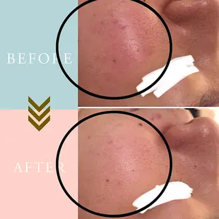 ニキビケア/毛穴/ 赤み/自信の肌✨森園のエステ・リラクイメージ