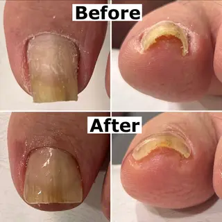 ネイル Mellow nail所属・巻爪無料モデル募集 ✨🦶MEGUMIのネイルデザイン