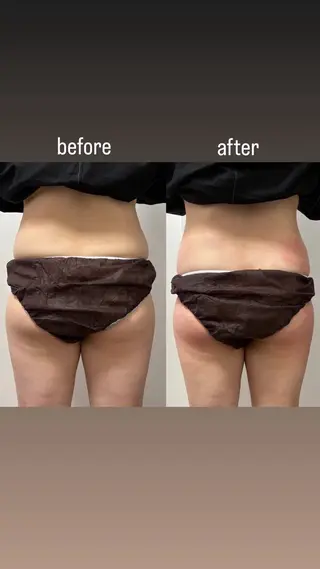 Miiju.所属・Miiju. 石巻市 脂肪冷却  鈴木のエステ・リラクイメージ