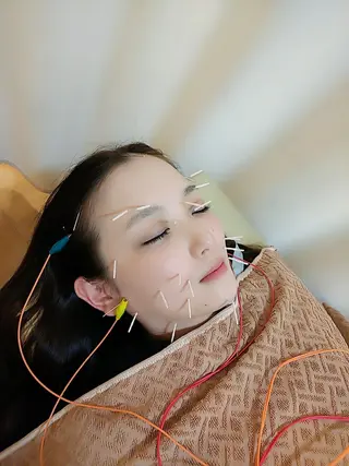 リフトアップ・たるみ ☆美容鍼小顔矯正のその他イメージ