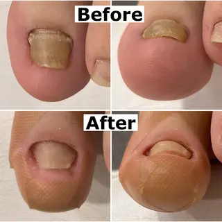 ネイル Mellow nail所属・巻爪無料モデル募集 ✨🦶MEGUMIのネイルデザイン