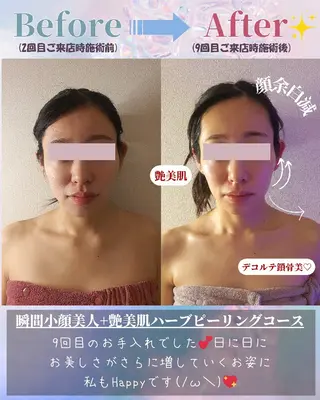 痩身ハーブピーリング 筋膜リリース☆B&Hのエステ・リラクイメージ