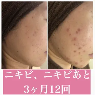 ニキビ跡改善専門🔥 医療にはできない改善のエステ・リラクイメージ