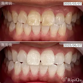 セルフホワイトニング RipiQaのその他イメージ
