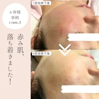 和漢よもぎ蒸しとフェイシャルのお店　maison de beaute所属・よもぎ蒸し/ 大人ニキビ　mamiのエステ・リラクイメージ