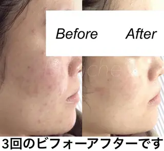 ミディアム カラー パーマ ヘアアレンジ キッズ ネイル マツエク・マツパ 都度払い肌質改善 &脱毛Blancheのエステ・リラクイメージ