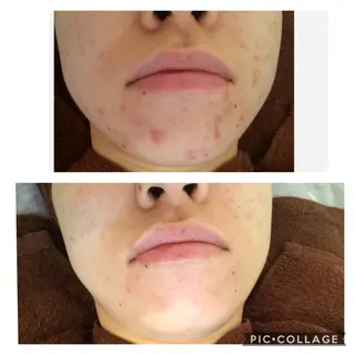 ニキビ/肌質改善専門 Snow skinのエステ・リラクイメージ