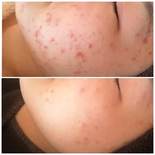 セミロング カラー パーマ ヘアアレンジ メンズ キッズ ネイル マツエク・マツパ アイブロウ ニキビ特化型エステ 🍓最短で肌質改善のエステ・リラクイメージ