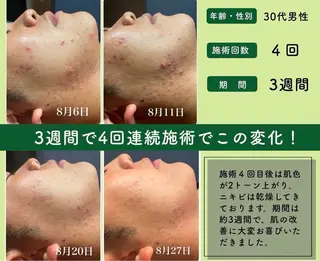 M.plus所属・水光韓国肌ハーブ ピーリングMplusのエステ・リラクイメージ