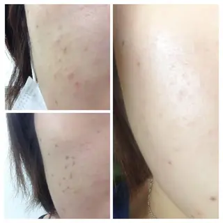 【ニキビ/肌管理】 salon varyのエステ・リラクイメージ