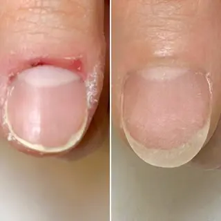 メンズ ネイル 深爪矯正専門店　ネイルサロン　トイロ所属・ネイルサロン トイロのネイルデザイン