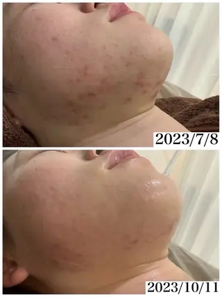 脱毛・ハーブピーリング専門サロン bida m所属・🌷あいり 🌷のエステ・リラクイメージ