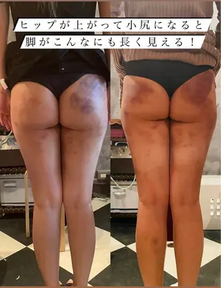 セルライトクラッシュ ＆腸もみ＋骨盤矯正のエステ・リラクイメージ