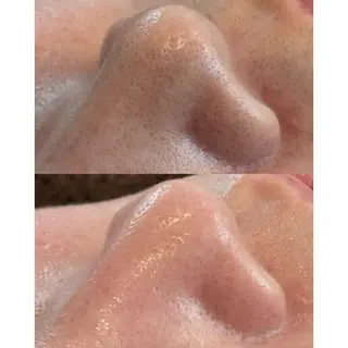 himee所属・艶肌ハーブピーリング /毛穴洗浄のエステ・リラクイメージ