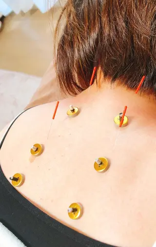 HARIKA鍼灸所属・HARIKA 鍼灸のその他イメージ