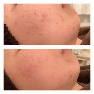 ミディアム カラー パーマ ヘアアレンジ メンズ キッズ ネイル マツエク・マツパ ニキビ跡専門サロン Ainaのエステ・リラクイメージ