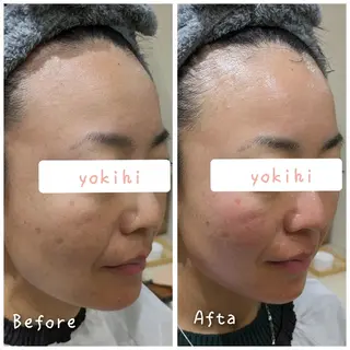 結果が出るスキンケア 肌質改善/まつパのエステ・リラクイメージ