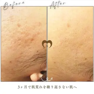 ニキビケア/毛穴/ 赤み/自信の肌✨森園のエステ・リラクイメージ