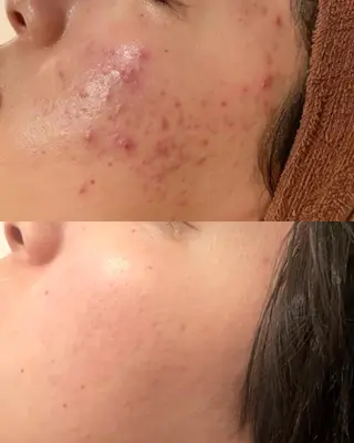 夏までに肌荒れ卒業 するサロン🌻のエステ・リラクイメージ