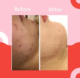 ニキビ跡改善専門🔥 医療にはできない改善のエステ・リラクイメージ
