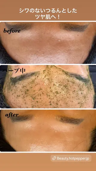 ハーブピーリング/韓国肌管理/フェイシャル/毛穴洗浄/眉毛/顔脱毛【糸脱毛専門】rev所属・ハーブピーリング🌹 毛穴洗浄❤️眉waxのエステ・リラクイメージ